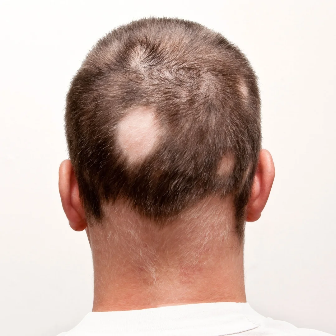 Alopecia Areata Treatment in Bhopal