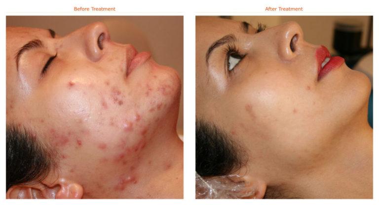 Acne Scar Treatment