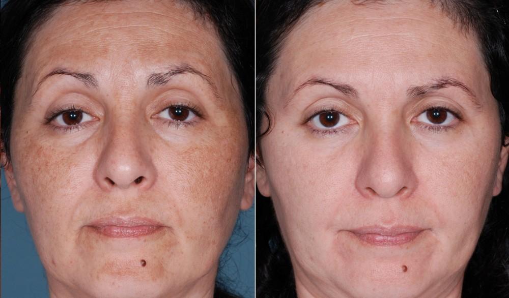 Chemical Peel