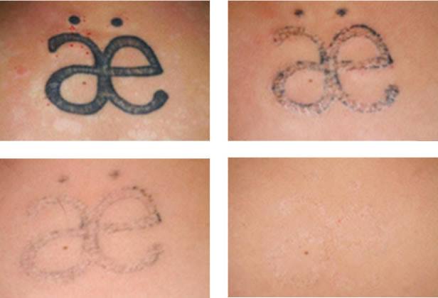 Laser Tattoo Removal