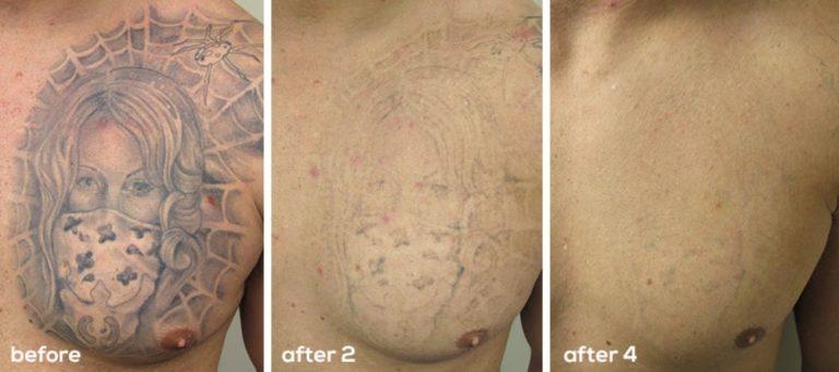 Laser Tattoo Removal