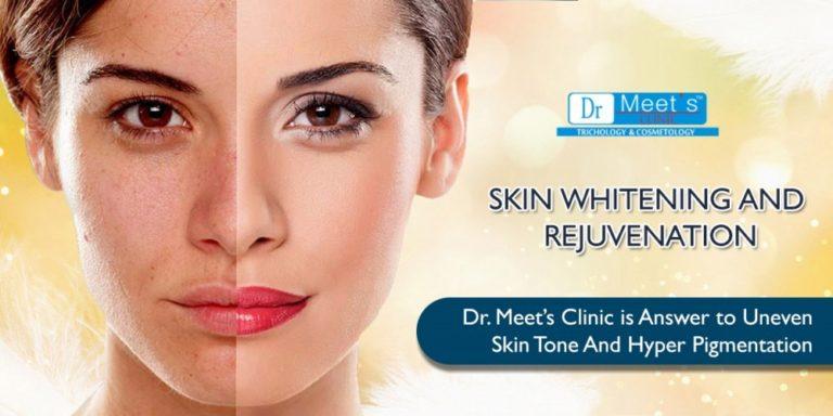 Skin Whitening Treatments