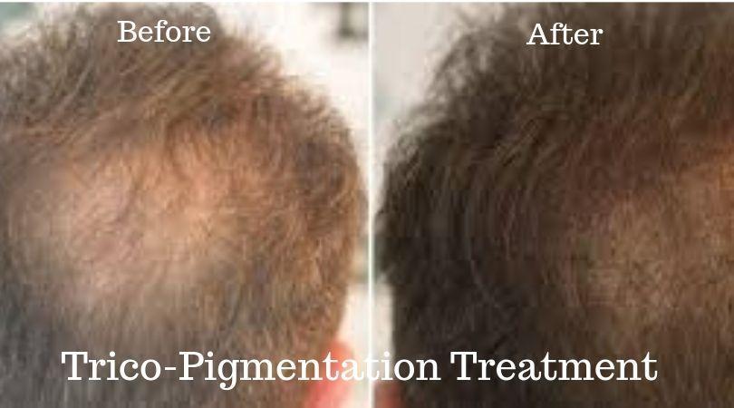 Trico Pigmentation Treatment|Trico Pigmentation Treatment