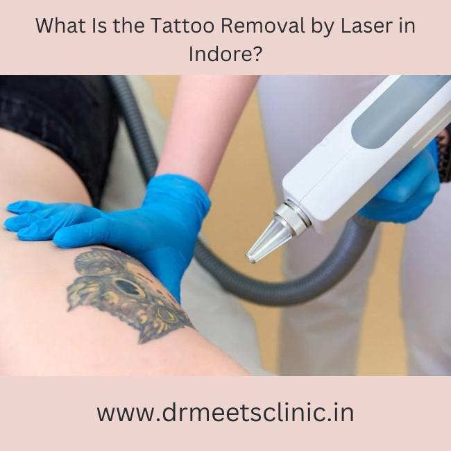 Tattoo Removal by Laser in Indore