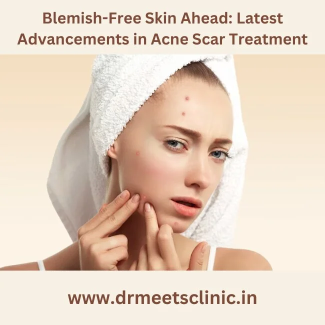 acne scar treatment