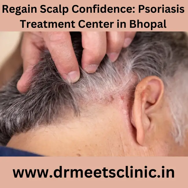 Psoriasis Treatment Center in Bhopal.