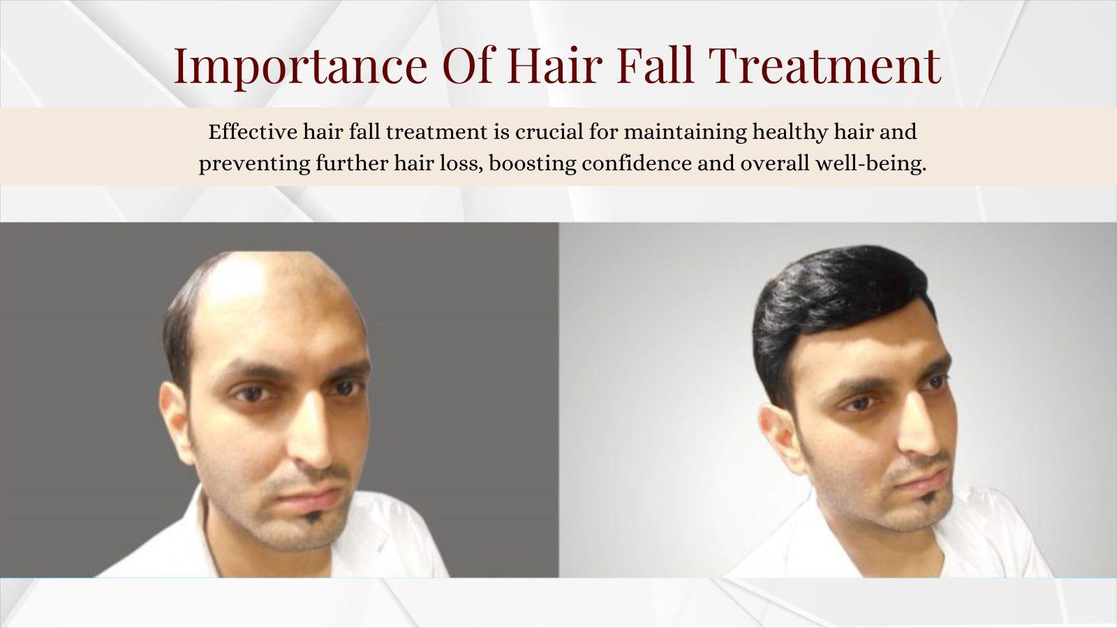 Importance Of Hair Fall Treatment