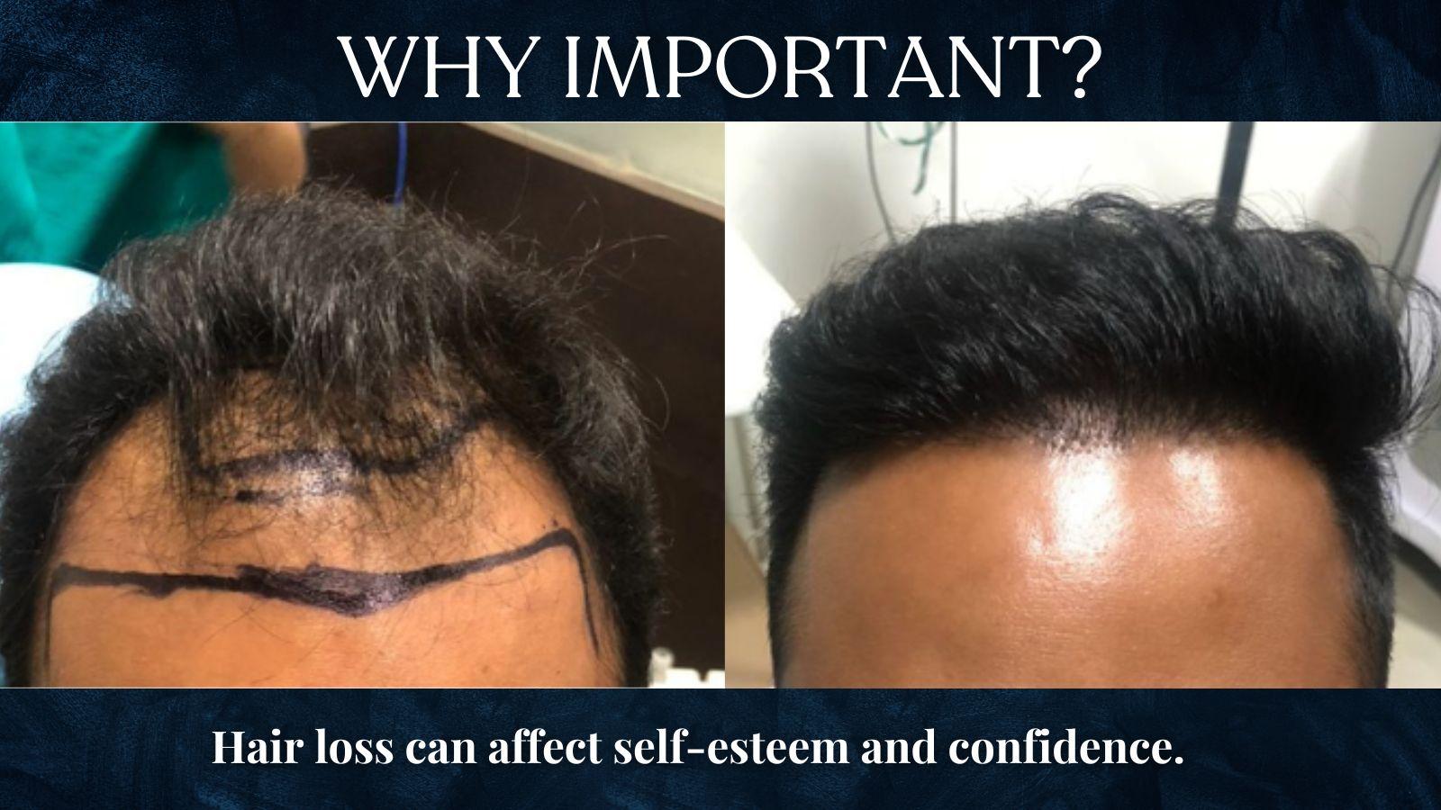 What Is The Importance of Hair Fall Treatment?