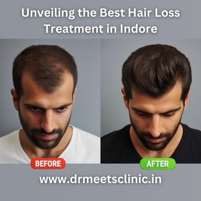 Unveiling the Best Hair Loss Treatment in Indore