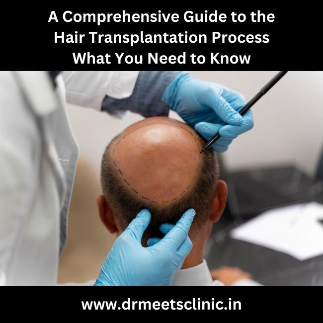 hair transplantation in Indore