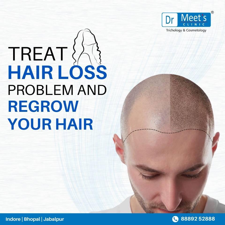 Hair Fall Treatment in Govind Pura, Bhopal: An In-depth Guide