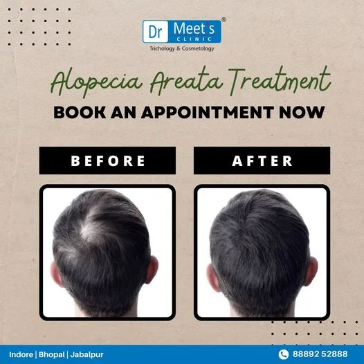 Hair Fall Treatments in Old Palasia, Indore