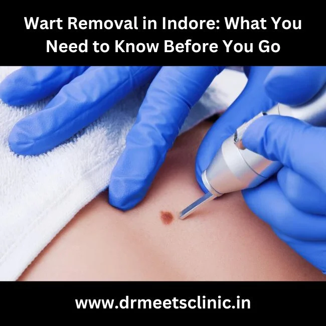 Wart Removal in Indore What You Need to Know Before You Go