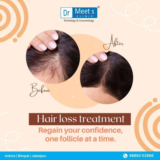 Hair Fall Treatment in Sapna Sangeeta Road, Indore