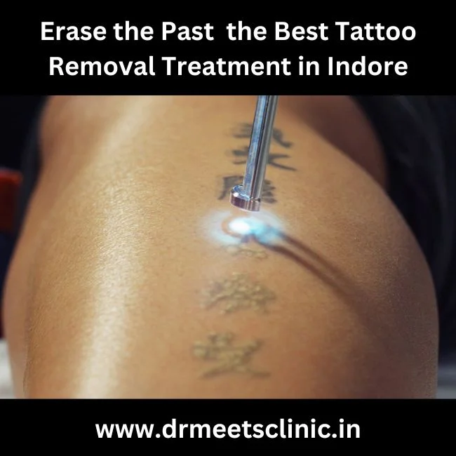 Best Tattoo Removal Treatment in Indore