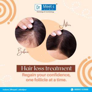 Hair Fall Specialists in Khajrana Road, Indore