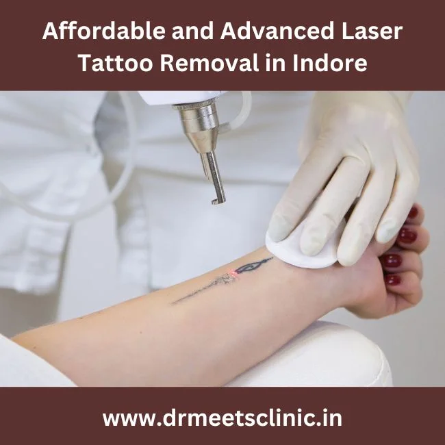 Laser Tattoo Removal in Indore