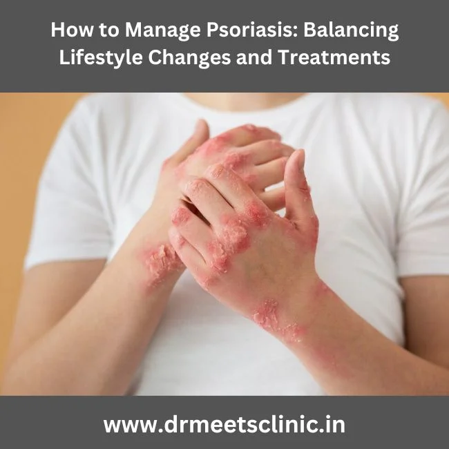 psoriasis treatment in Indore