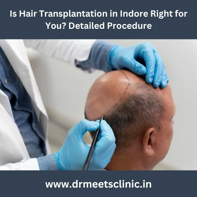 Hair Transplantation in Indore