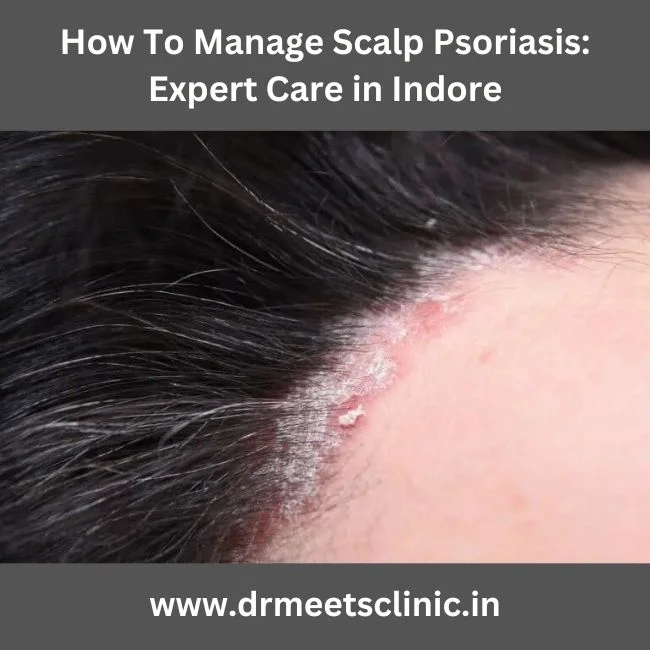 Scalp Psoriasis