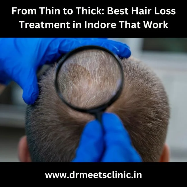 Best Hair Loss Treatment in Indore