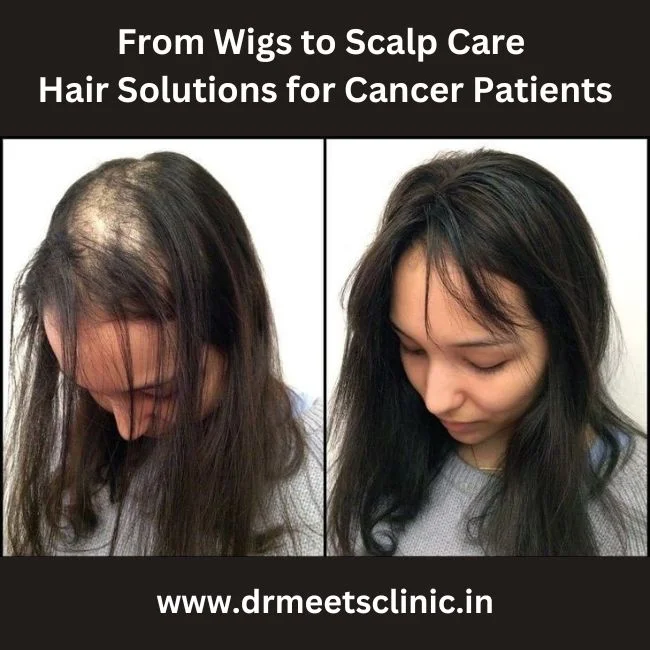 hair solutions for cancer patients