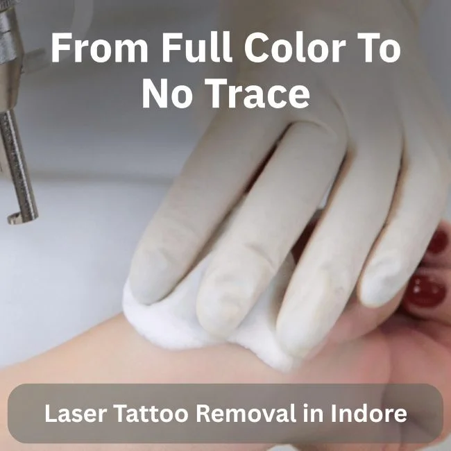 Laser Tattoo Removal in Indore