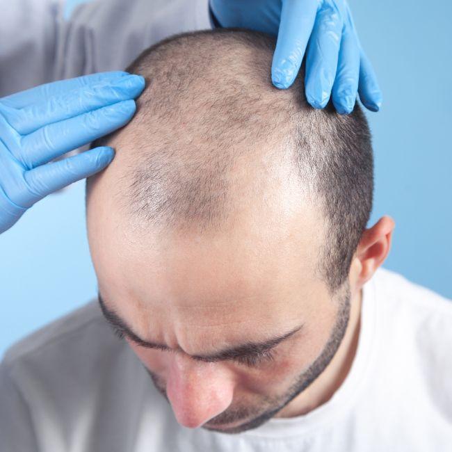 best hair doctor in bairathi colony indore