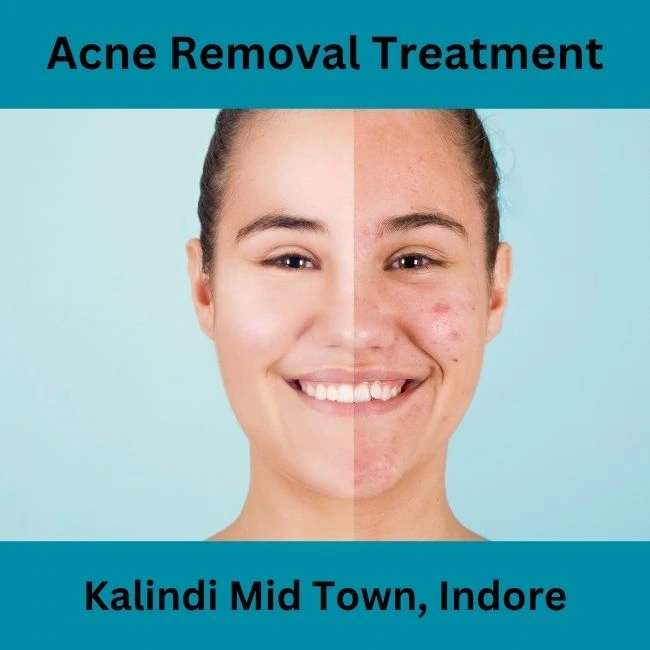 acne removal treatment near kalindi mid town indore