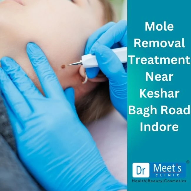 Mole Removal Treatment Kesar Bagh Road