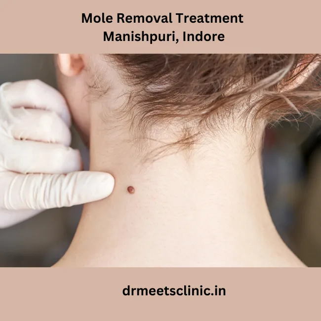 Mole Removal Treatment