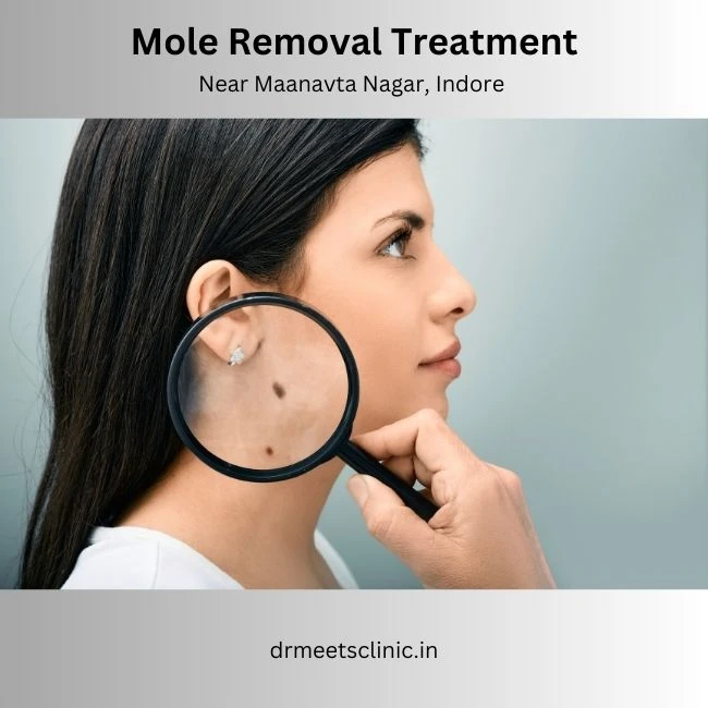 Mole Removal Treatment Near Maanavta Nagar, Indore