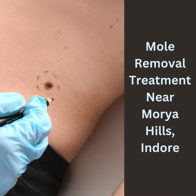 Mole removal morya hills