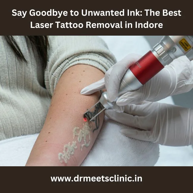 Best Laser Tattoo Removal in Indore