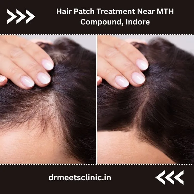 Hair Patch Treatment Near MTH Compound, Indore