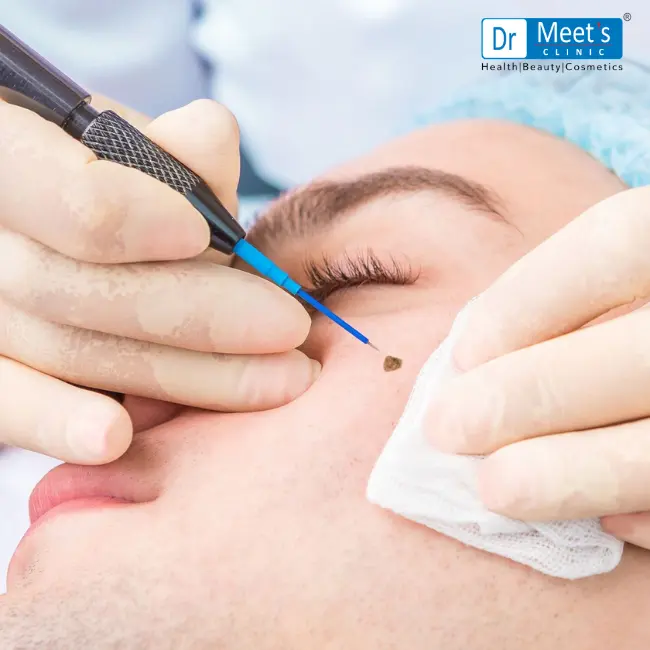 mole removal palakhedi