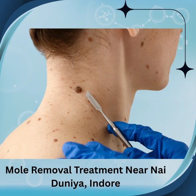 Mole Removal Treatment Near Nai Duniya, Indore