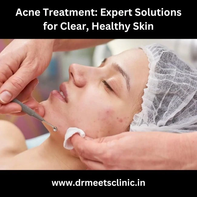 Acne Treatment