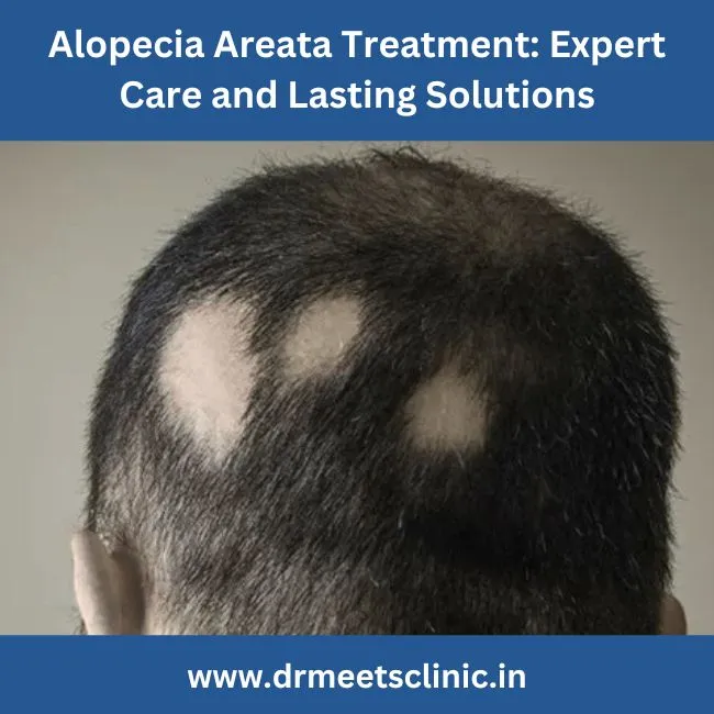 Alopecia Areata Treatment