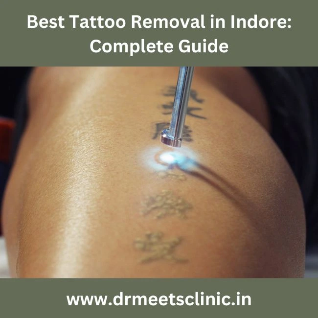 Best Tattoo Removal in Indore