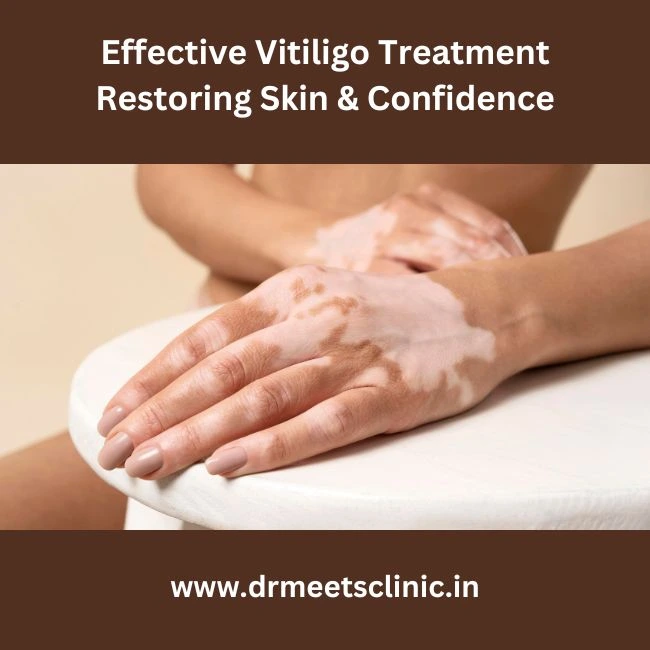 Vitiligo Treatment