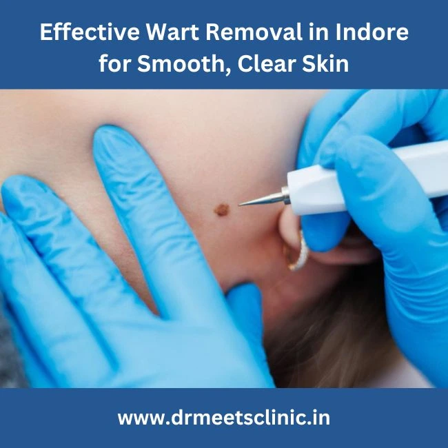 Wart Removal in Indore