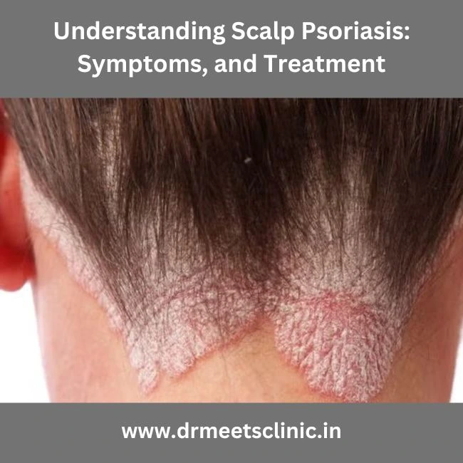 Scalp Psoriasis