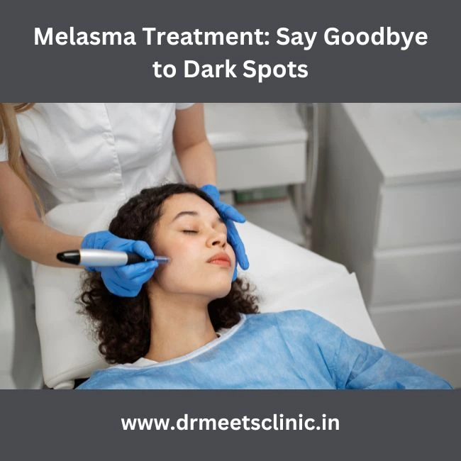 Melasma Treatment