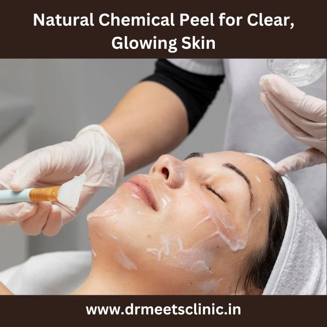 Natural Chemical Peel