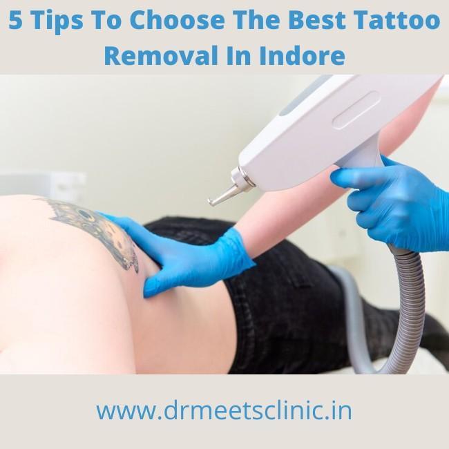 Best Tattoo Removal In Indore