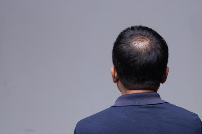 Consulting a dermatologist for Hair Loss Treatment