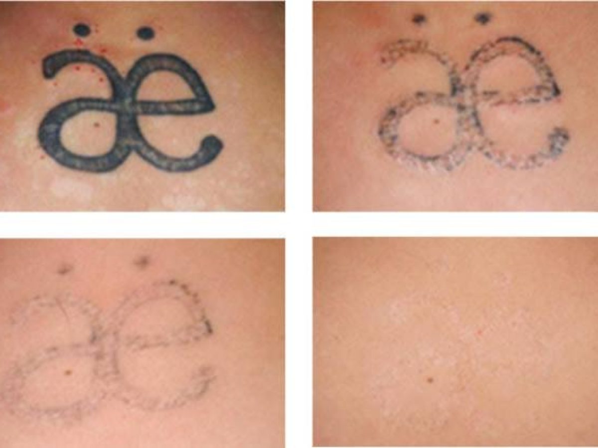 How To Choose The Right Laser Tattoo Removal Clinic?