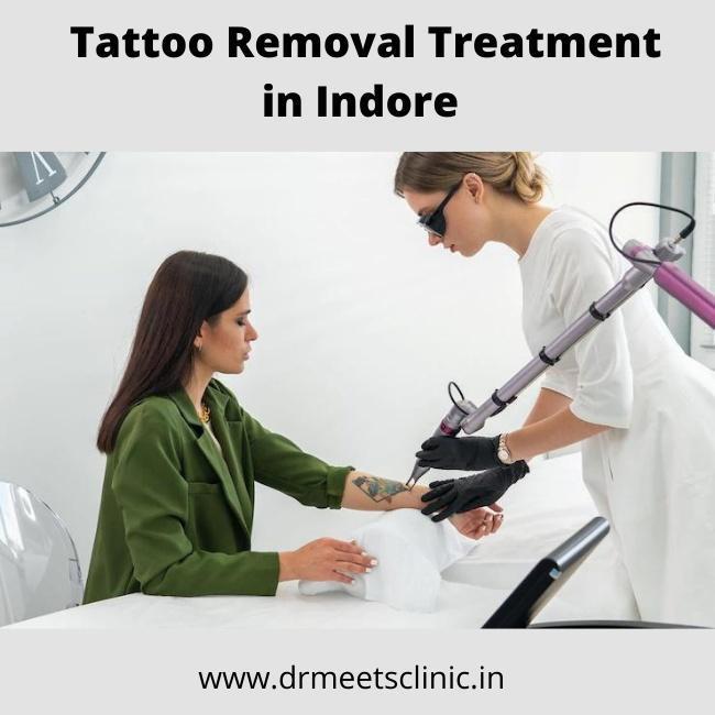Best Tattoo removal treatment in Indore
