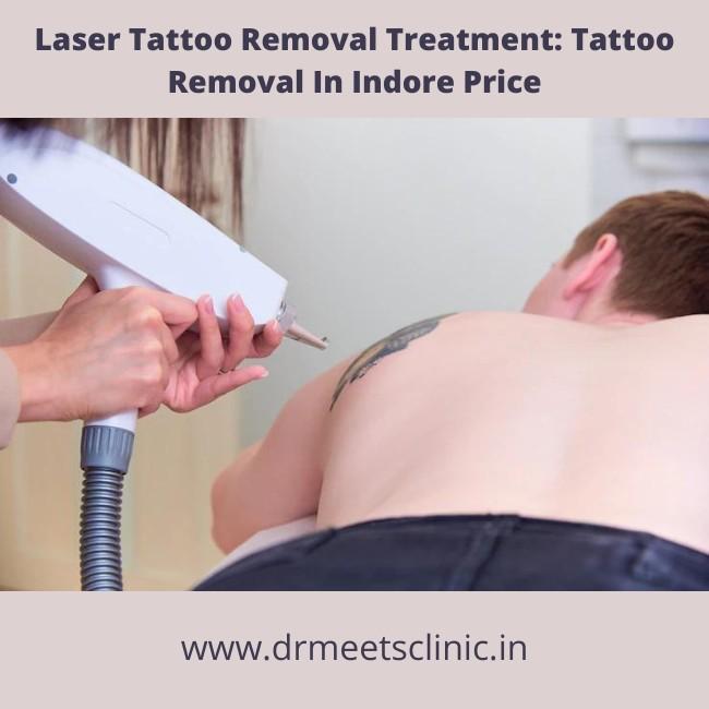 Tattoo removal in Indore price
